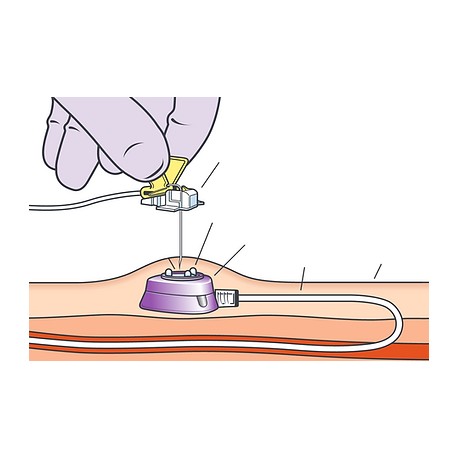 Cateter Totalmente Implantável para Quimioterapia