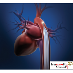 Cateter para Terapia de balão intra-aórtico