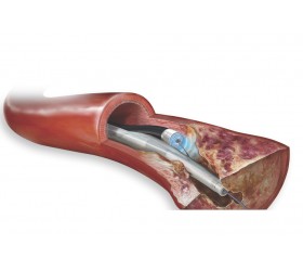 Cateter Guia a Laser com Cateter de Aterectomia a Laser Turbo-Tandem